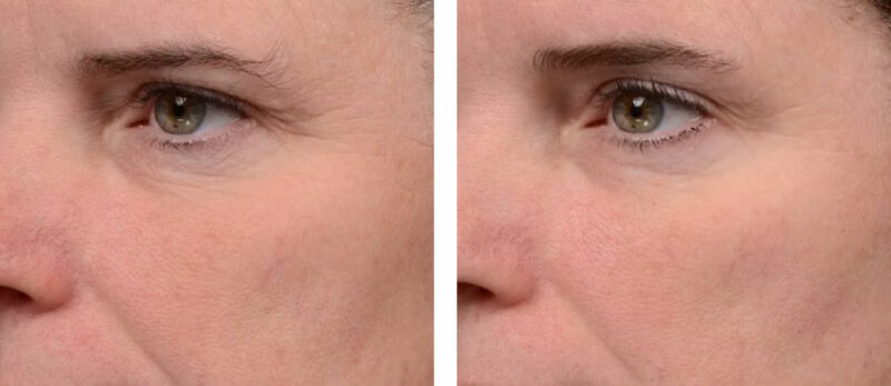 Week 0, Week 12 | Improvement to Puffiness and Visible Fine Lines and Wrinkles